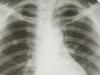 cancer_pulmonar.jpg