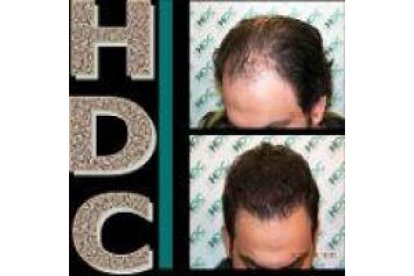 Implant de Par HDC - Picture2.jpg