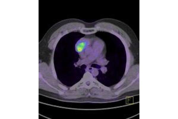 Centrul de Diagnostic Pozitron Diagnosztika PET CT - PET_CT.jpg