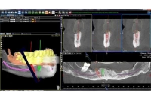 Dr.Cristian Gheorghiu - medic dentist implantolog - 1planificare_3d.jpeg