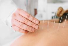 Beneficiile acupuncturii