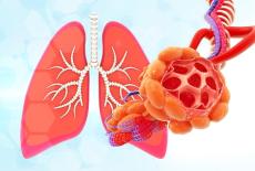 Explorarea bolilor rare pulmonare: prezentare, diagnostic si tratament