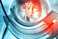 Cardiomiopatia dilatativa