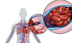 Trombembolismul pulmonar - factori de risc si masuri de prevenire