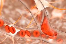 Cauzele infarctului intestinal