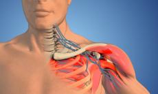 Paralizia de plex brahial - semne, diagnostic, tratament