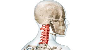 Siringomielia, o afectiune neurologica asociata cu malformatii congenitale ale creierului