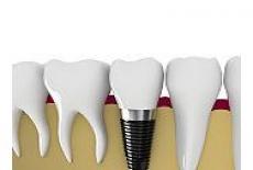 Totul despre implantul dentar