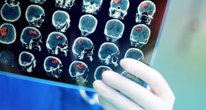 Depistarea primelor semne ale accidentului vascular cerebral