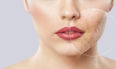 Ingrijirea tenului si tratarea acneei