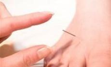 Ameliorarea durerilor artritice prin acupunctura 