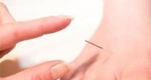 Ameliorarea durerilor artritice prin acupunctura 