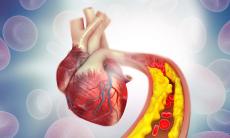 Arterita, vedere de ansamblu