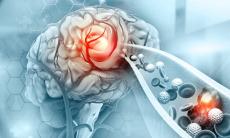 Cum putem recunoaste un accident vascular cerebral ?