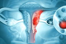 Cancerul ovarian, neoplasmul cu cea mai mica rata de supravietuire in randul femeilor