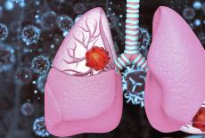 Cancerul pulmonar, ucigasul nr. 1