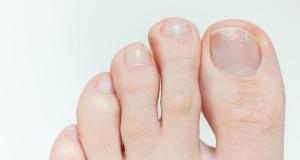 Ingrijirea unghiilor dupa tratamentul antifungic: Pasii esentiali pentru o recuperare completa