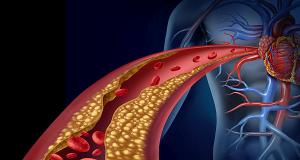 Scaderea colesterolului marit (hipercolesterolemie) cu cel mai popular supliment alimentar