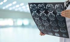 Hemoragia intracraniana