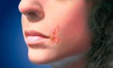 Impetigo