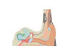 Implantul cohlear - electrozi la nivelul urechii interne