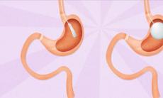 Inelul gastric, solutie impotriva obezitatii