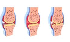 Factorii de risc pentru necroza avasculara