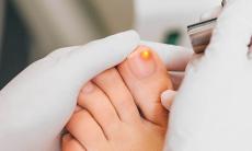 Trateaza micoza unghiei