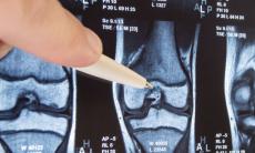 Semnele care va anunta ca suferiti de osteoporoza