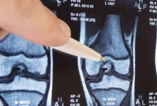 Semnele care va anunta ca suferiti de osteoporoza
