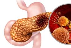 Pancreatita cronica (Inflamatia cronica a pancreasului)