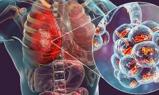 Bronsita sau pneumonie? Cum sa deosebesti aceste doua afectiuni