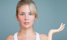 Rozaceea: patogenie, caracteristici clinice si diagnostic
