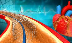 Ce este restenozarea de stent si cum o poti preveni?