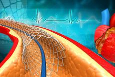 Ce este restenozarea de stent si cum o poti preveni?