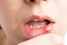 Stomatita – ce este si cum o putem trata