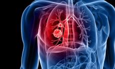 Care sunt complicatiile toracotomiei si cat dureaza recuperarea?