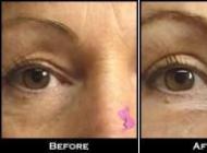 Blefaroplastie
