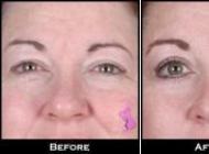 Blefaroplastie