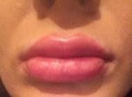 Marire buze cu acid hialuronic Princess